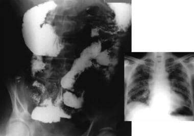 Small bowel barium study shows a dilated duodenum,