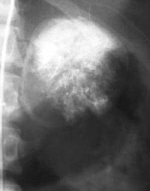 Selective adrenal angiogram demonstrates the highl