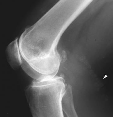 Lateral radiograph of the knee shows multiple calc