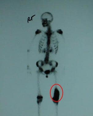 Delayed bone scan image of a 14-year-old girl. Act