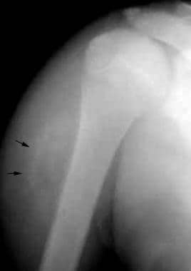 Anteroposterior radiograph of the right shoulder i