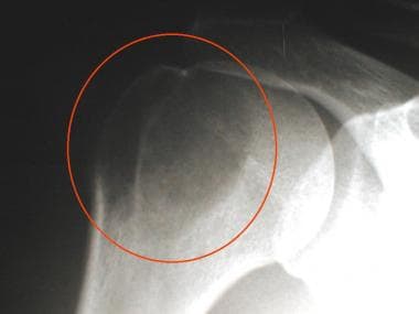 Radiograph of the right shoulder in a 39-year-old 
