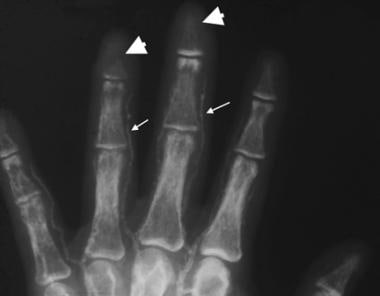 Anteroposterior radiograph of the fingers in a pat