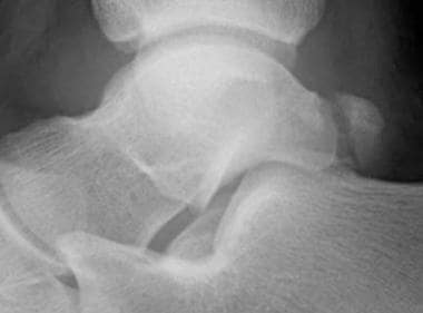Posterior process fracture, lateral radiograph. Th