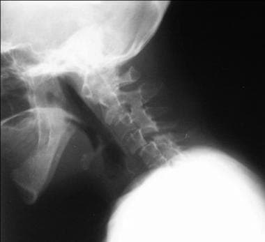 Lateral cervical spine conventional radiograph in 