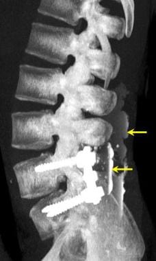 Lumbar spine trauma. Sagittal 3-dimensional surfac