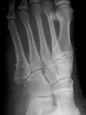 Fractured metatarsals. Transverse fracture of the 