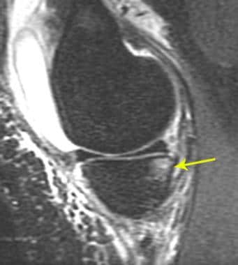 Contrecoup medial bone bruise of the tibia in a pa