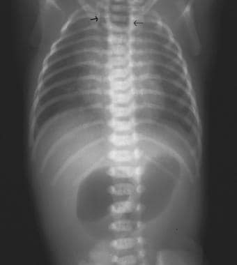 Anteroposterior projection of the chest and abdome