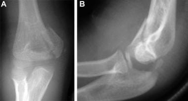 Medial condyle fracture. Anteroposterior (A) and l