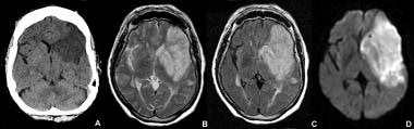Subacute infarct appears as a hypodensity on a CT 