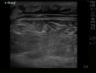 Ultrasound image demonstrating thickened, irregula