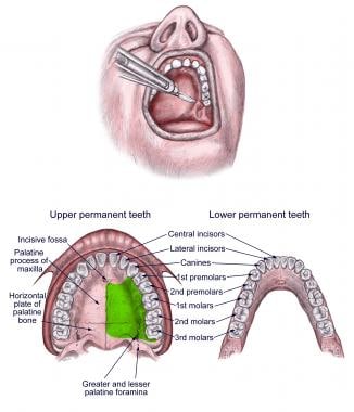 Greater palatine nerve block. 