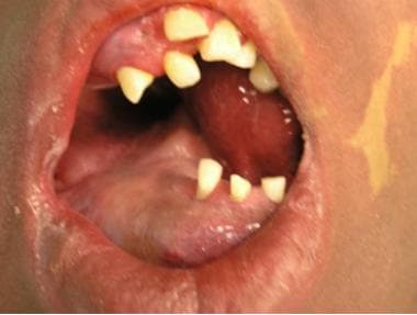 Intraoral component of venous malformation in the 