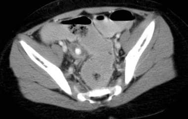 CT scan depicting distended tubular structure desc