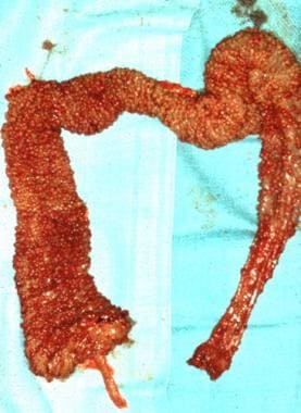 Surgical specimen of the colon in a patient with f