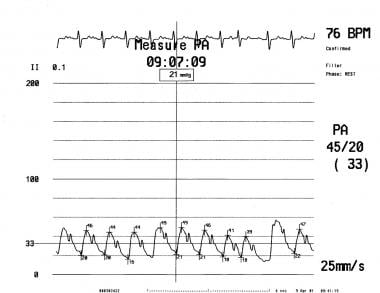 Pulmonary arterial pressure (Ppa) waveform. 