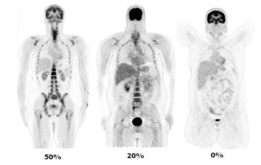 spect bone scan