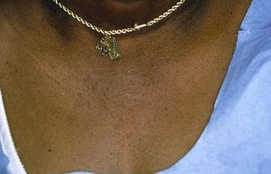 Allergic contact dermatitis to nickel in a necklac