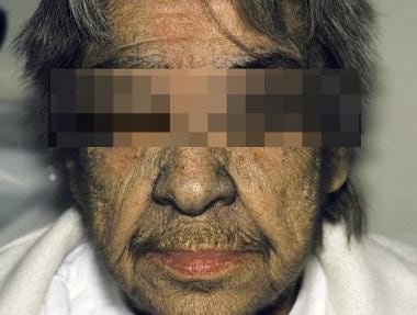 Idiopathic hirsutism in an elderly woman. 