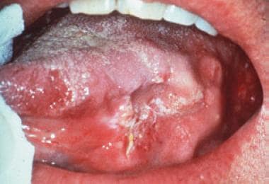 squamous cell carcinoma tongue