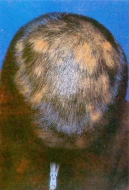 Discrete patches of hair loss or alopecia caused b