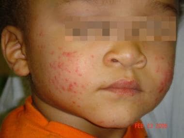 Characteristic erythematous papules of Gianotti-Cr