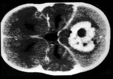 CT scan with contrast, axial view shows moderately
