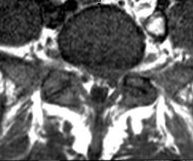Axial T1-weighted image shows protrusion of a left