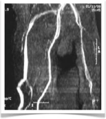 CT angiogram of patient with Klippel-Trenaunay syn