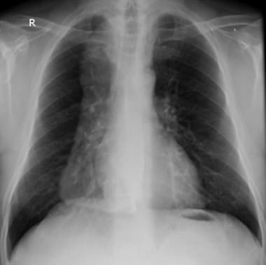 Chest radiograph in patient with achalasia.