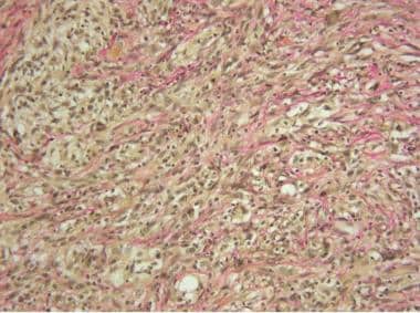 Histology section of a gliosarcoma with Van Gieson