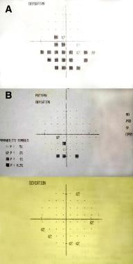 In A, final preoperative visual field of same pati