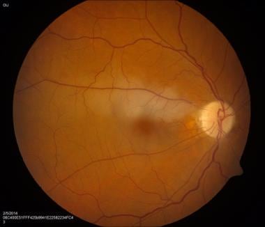 Color fundus photo of right eye with superior bran