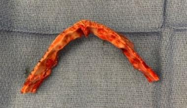 Intraoperative view of released fronto-orbital ban