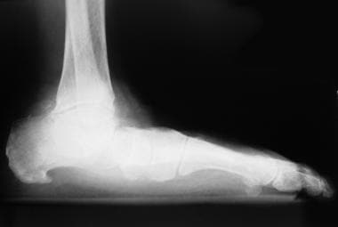 Medial arch collapse associated with valgus deform
