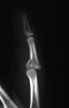 middle phalanx fracture