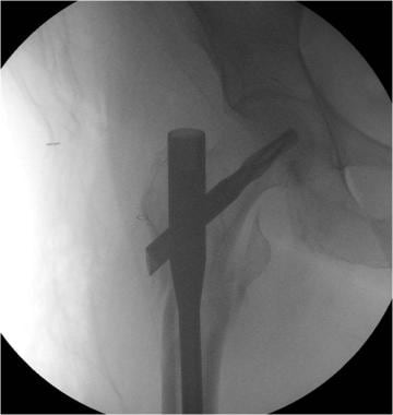Subtrochanteric femur fracture repaired with cepha