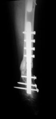 Supracondylar femur fracture treated by retrograde