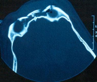 Fracture of the frontal sinus involving the anteri