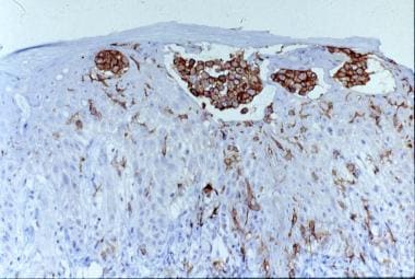 Immunohistochemical staining with CD-1a shows posi