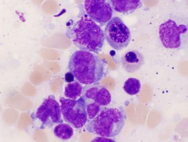 Hypogranular subtype of acute promyelocytic leukem