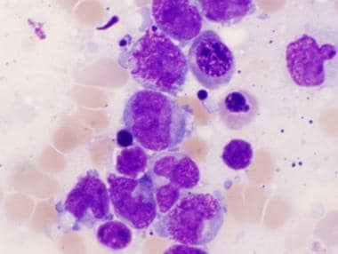 acute promyelocytic leukemia microgranular variant