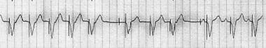 Pacemaker Malfunction. Termination of pacemaker-me