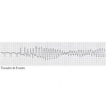 This electrocardiogram reveals torsade de pointes.
