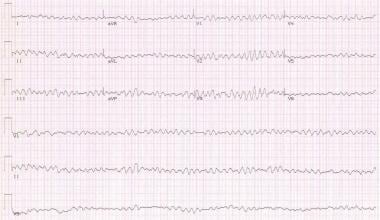 Heart Failure. Electrocardiogram depicting ventric