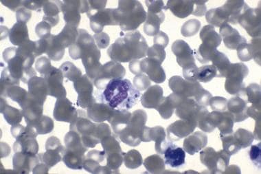 Gram stain of blood showing the presence of Neisse