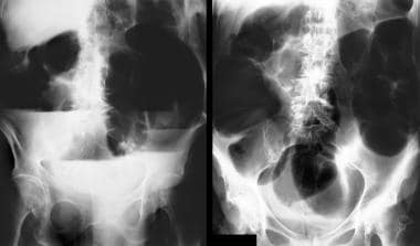 Toxic Megacolon. A 72-year-old woman presented wit