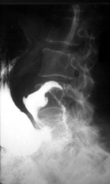 Upper gastrointestinal series shows duodenal lipom