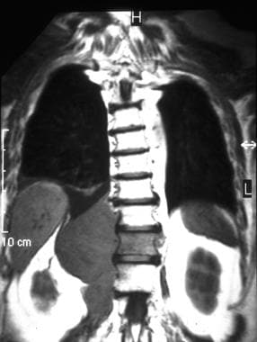 T1-weighted coronal MRI of the thorax in a 55-year